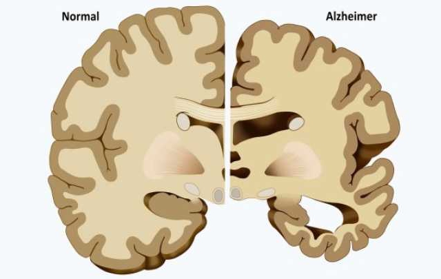 Cambios morfológicos del cerebro afectado por Alzheimer