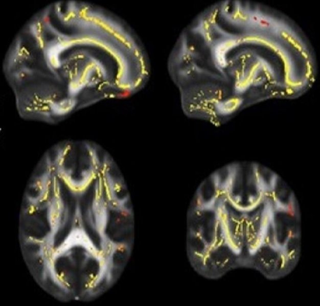 Imágenes del cerebro que muestran la funcionalidad de la materia blanca en los sujetos del estudio Imágenes del cerebro que muestran la funcionalidad de la materia blanca en los sujetos del estudio